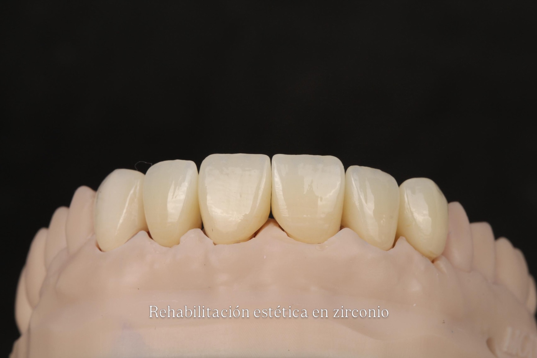 Restauración estética en zirconio sobre un modelo dental, publicada por la doctora